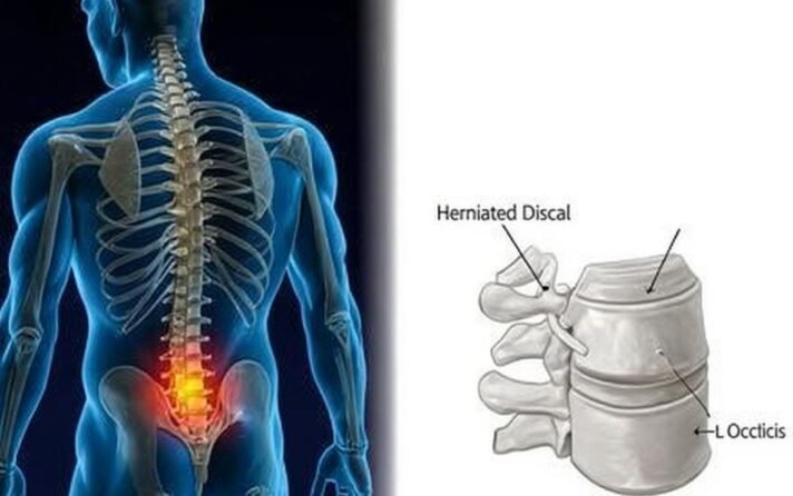 Columna: Hernia discal